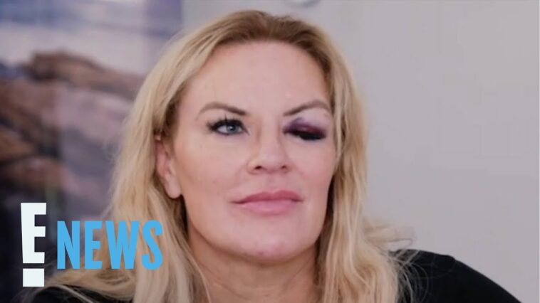 RHOSLC's Heather Gay Finally Comes Clean About Her Black Eye Mystery | E! News