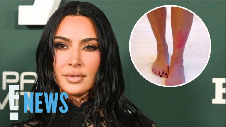 See Kim Kardashian’s PAINFUL Psoriasis Flare Up on Her Leg | E! News